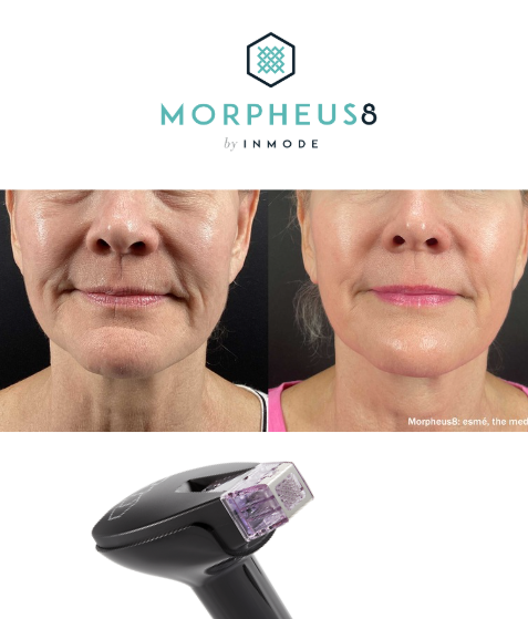Maximize Your Results: Essential Aftercare for Tixel, Morpheus8, and IPL Treatments