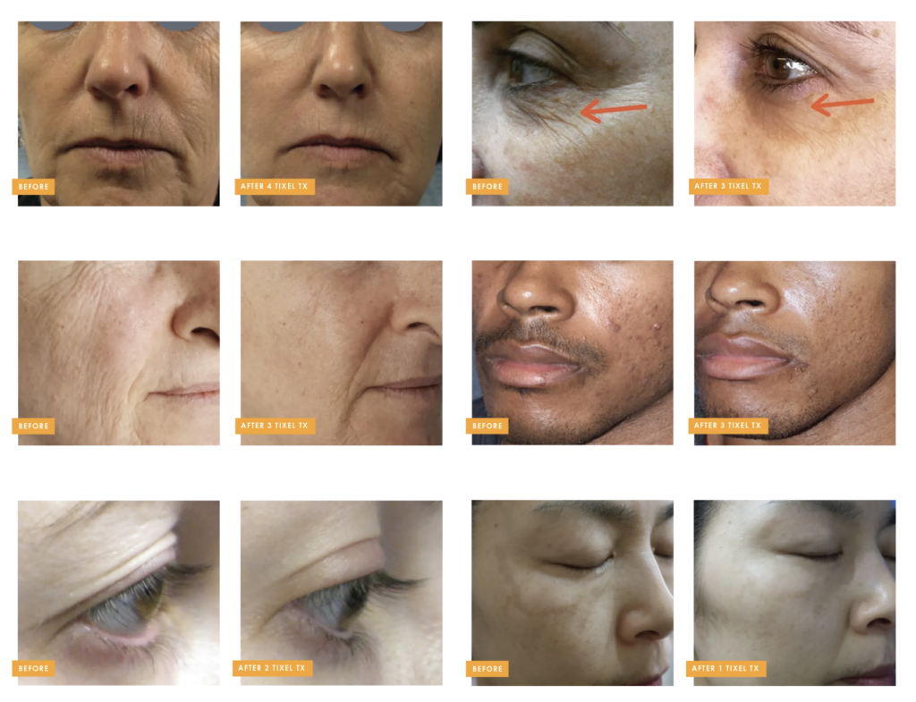 Supercharge Your Skin: The Novoxel Tixel Difference in Anti-Aging
